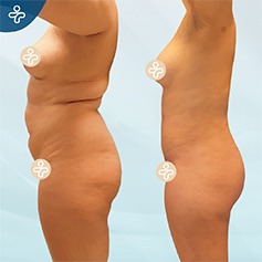Before and after body contouring and body sculpting results showing slimmer waist and improved body shape