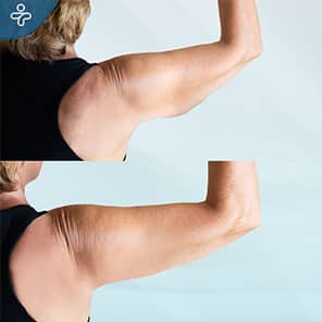 Arm Lift Patient Before After