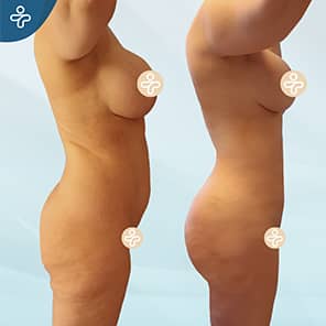 BBL Patient Before After