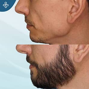 Barttransplantation Patient Vorher Nachher