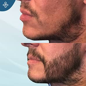 Barttransplantation Vorher Nachher