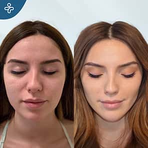 Bichectomy Patient Before After