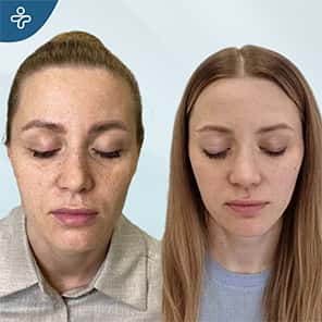 Bichectomy Patient Before After