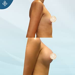 Breast Augmentation Patient Before After