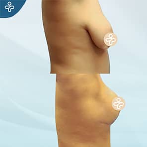 Breast Lift Patient Before After