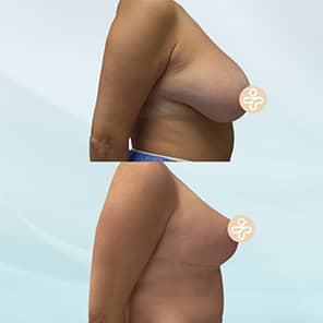 Breast Reduction Patient Before After