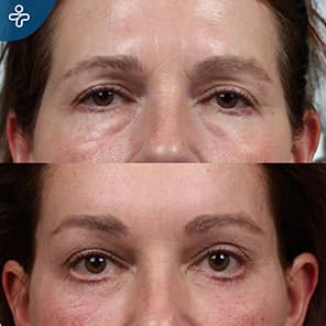 Augenbrauenlifting Patient Vorher Nachher