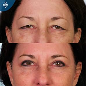 Augenbrauenlifting Patient Vorher Nachher