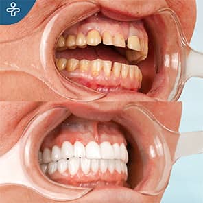 Dental Crowns Patient Before After