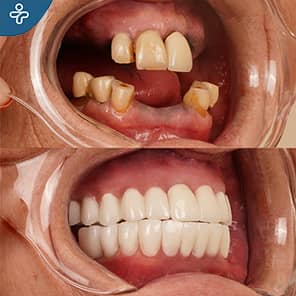 Dental Implants Patient Before After