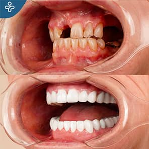 Dental Implants Before After