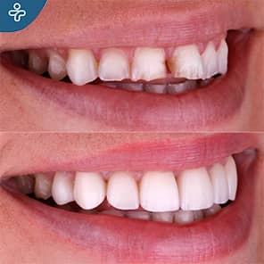 Dental Veneers Patient Before After