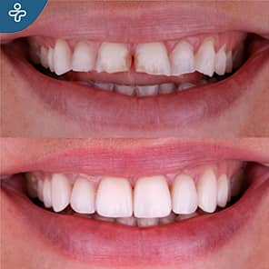 Dental Veneers Before After