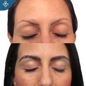 Greffe de sourcils patient avant après
