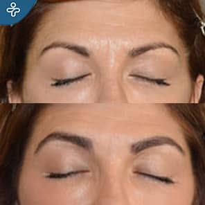 Greffe de sourcils avant après