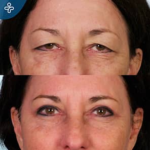 Blepharoplasty Patient Before After