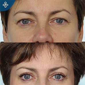 Blepharoplasty Patient Before After