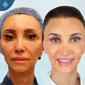 Facelift Patient Before After