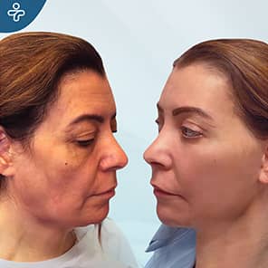 Facelift Patient Before After