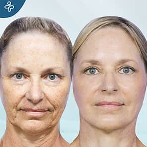 Fat Transfer to Face Patient Before After