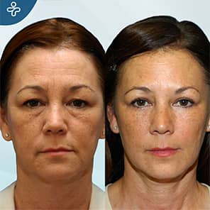 Fat Transfer to Face Patient Before After
