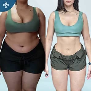 Gastric Bypass Before After