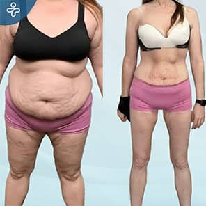 Gastric Sleeve Patient Before After