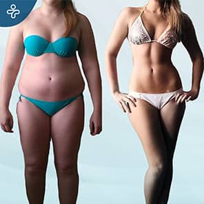 Gastric Sleeve Before After