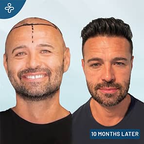 Hair Transplant Patient Before After