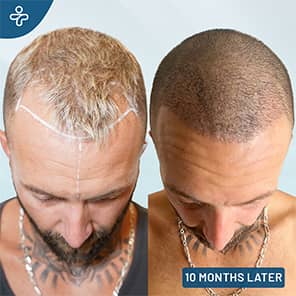Hair Transplant Before After