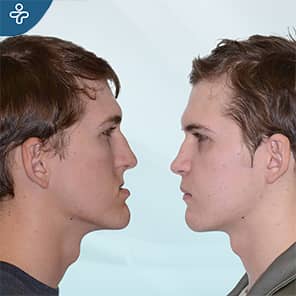 Jaw Surgery Patient Before After