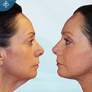 Neck Lift Patient Before After
