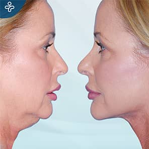 Neck Lift Patient Before After