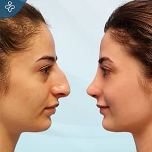 Rhinoplasty Patient Before After