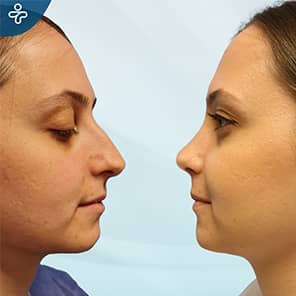 Rhinoplasty Patient Before After