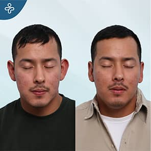 Otoplasty Patient Before After