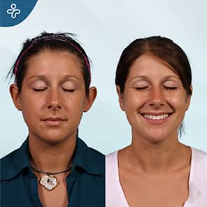 Otoplasty Patient Before After