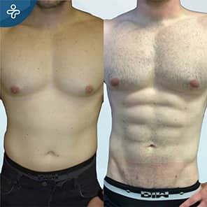 Six Pack Surgery Patient Before After