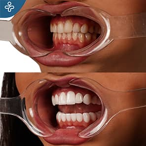 Smile Design Before After