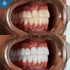 Blanqueamiento dental paciente antes después