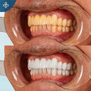 Blanqueamiento dental antes después