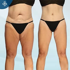 Thigh Lift Patient Before After