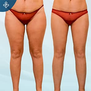 Thigh Lift Patient Before After