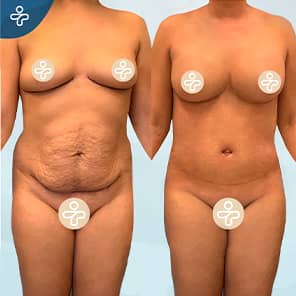 Tummy Tuck Patient Before After