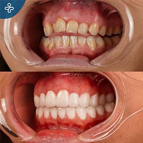 Zirconium Crowns Before After