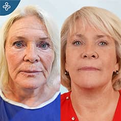 Vorher Nachher