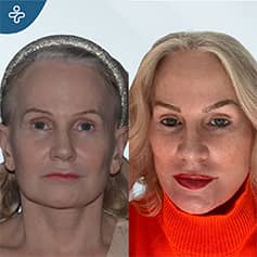 Vorher Nachher