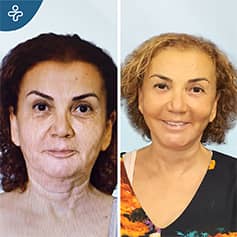 Before After