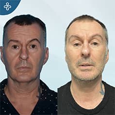 Before After