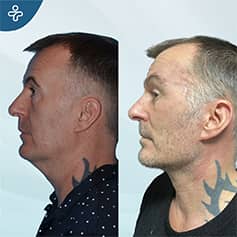Before After